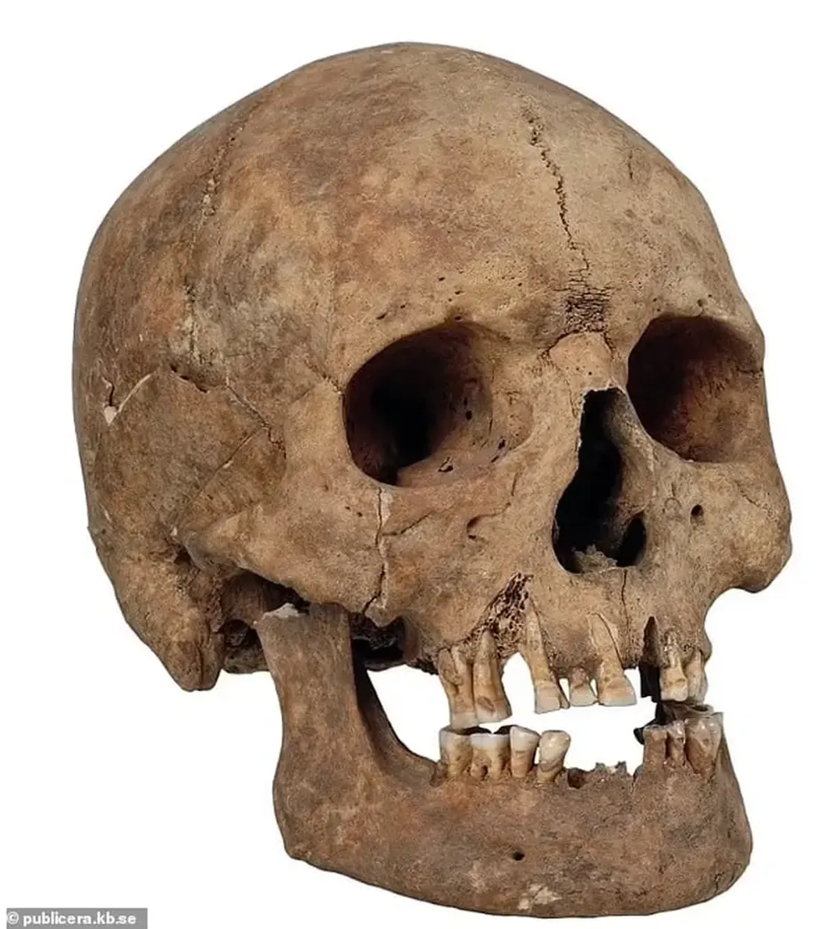 Viking Age Discoveries: Remains of Women with Abnormally Long Skulls Found