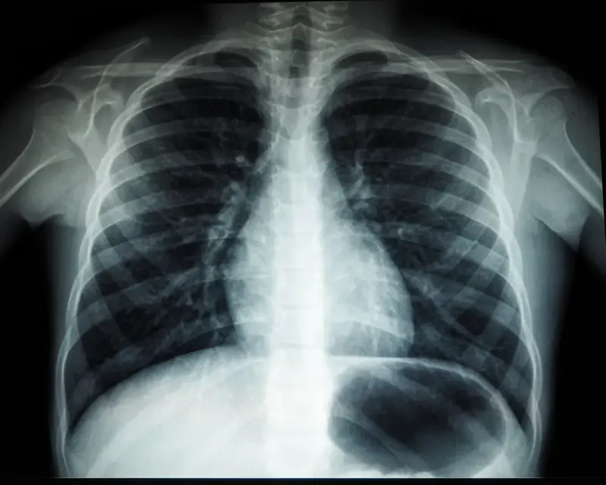 AI in Medicine: Diagnosing from X-ray Images
