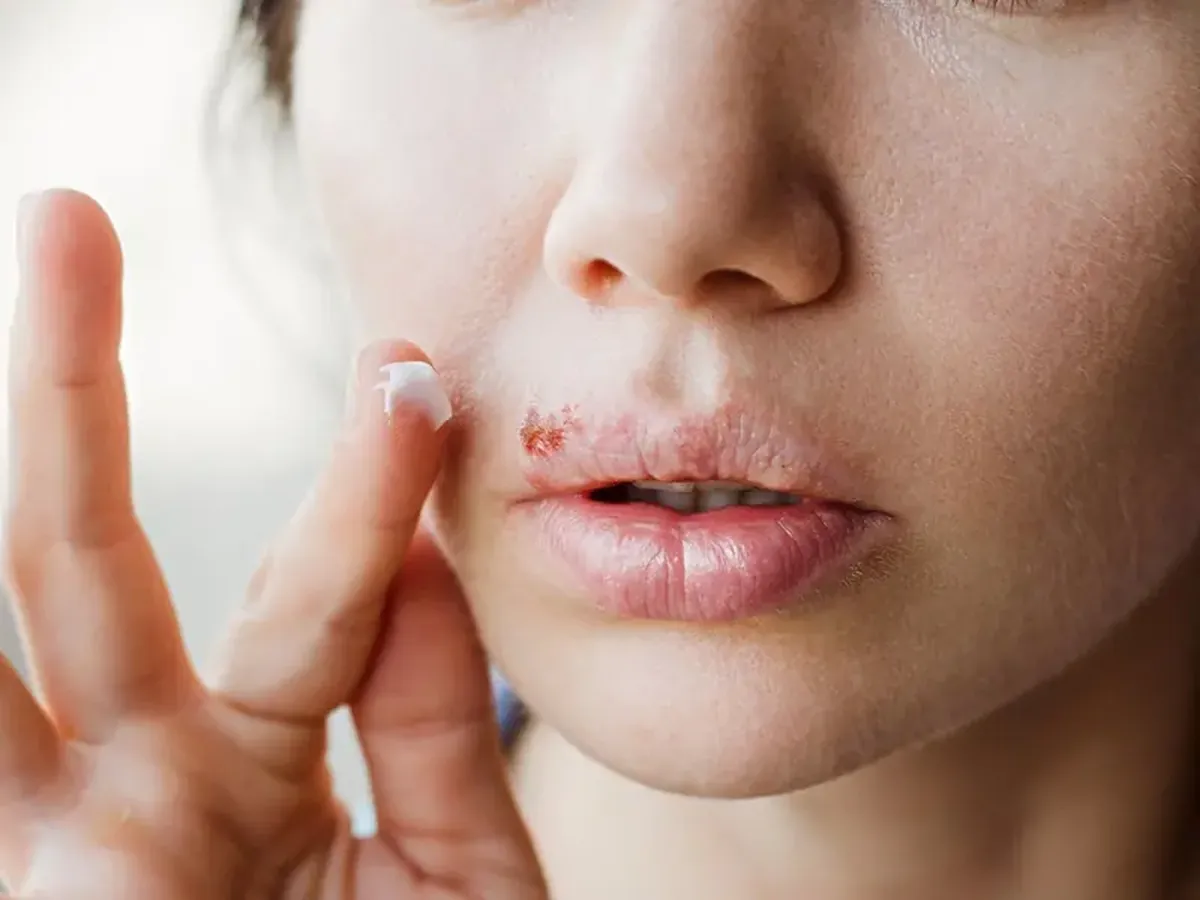 A Common Herpes Virus Could Help Trigger Alzheimer’s — Especially in People with APOE-ε4 3 Researchers have found a link between herpes and Alzheimer's disease.