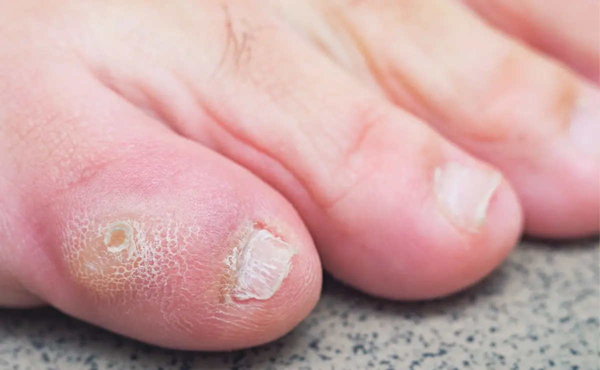 Corn on Toes