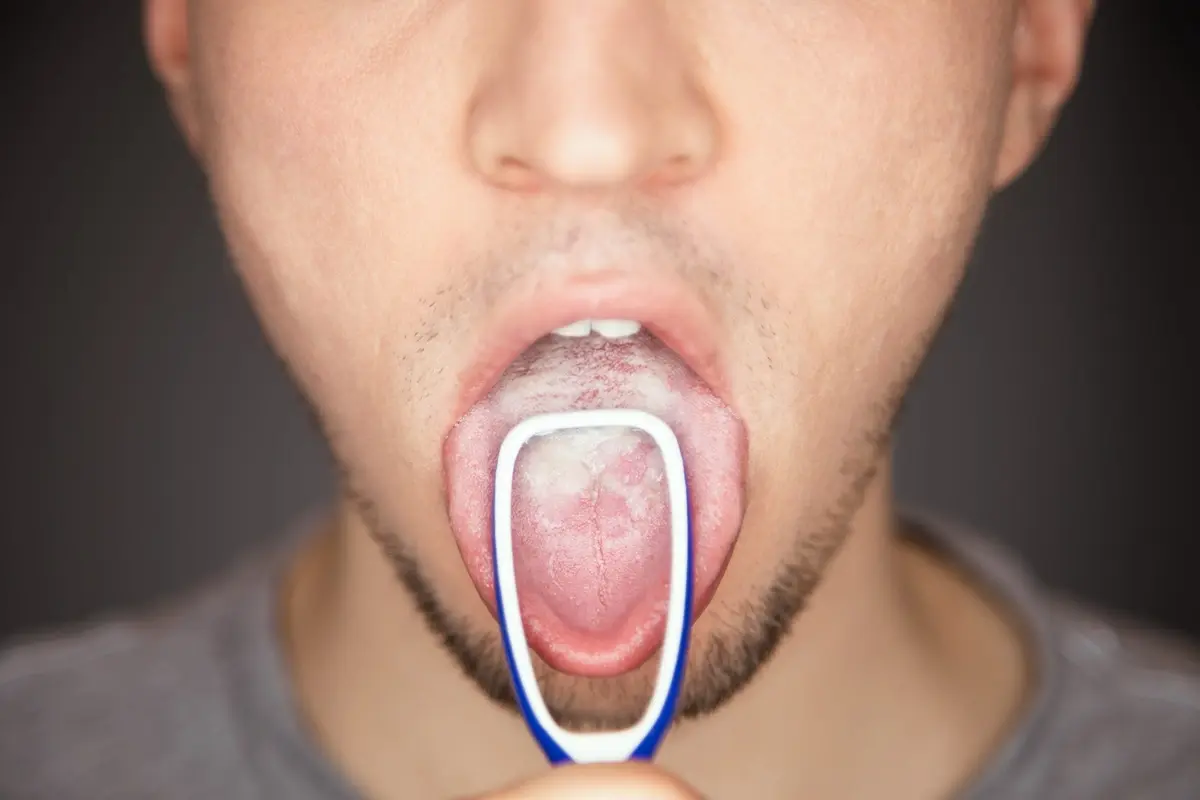 Why Your Mouth Tastes Bitter — What It Means and How to Fix It 5 White Tongue