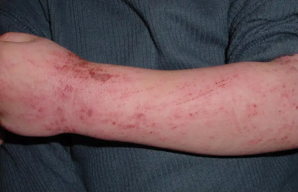 Problematic skin