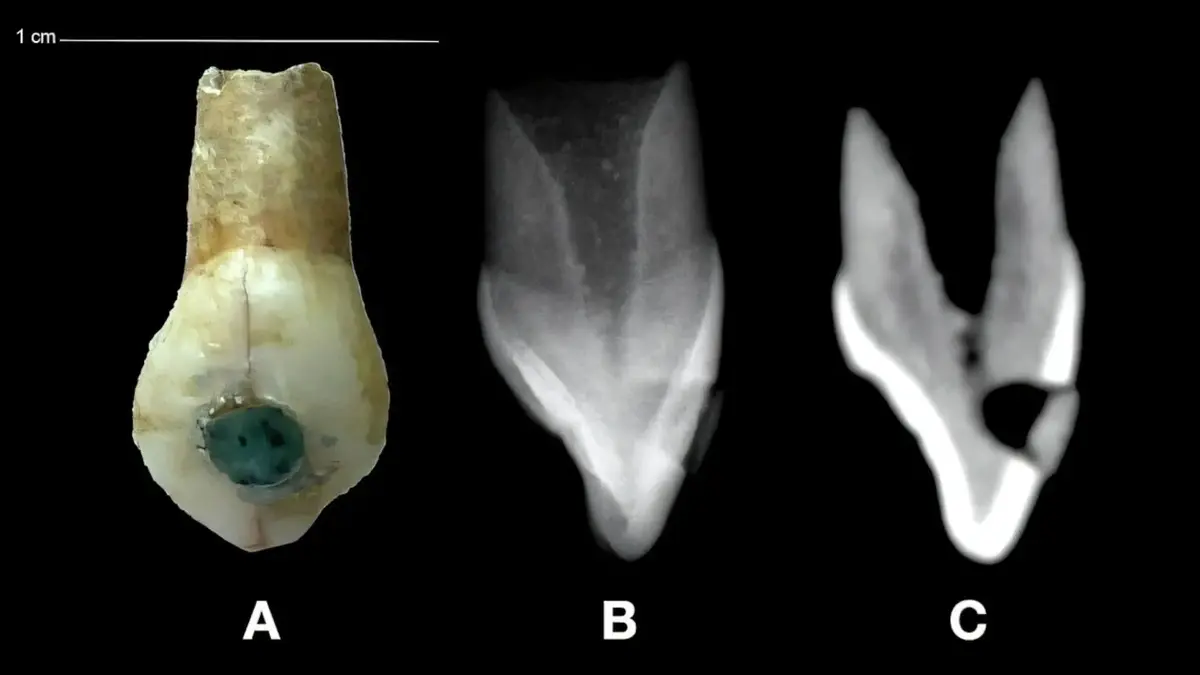 Ancient Maya Put Jade Inlays in Children's Teeth 4 children's teeth with precious inlays