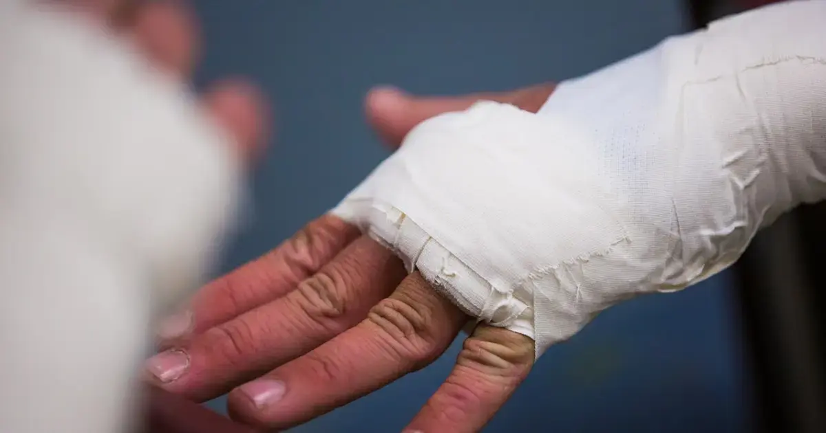 Scientists develop a glue gun to print bone grafts directly onto fractures