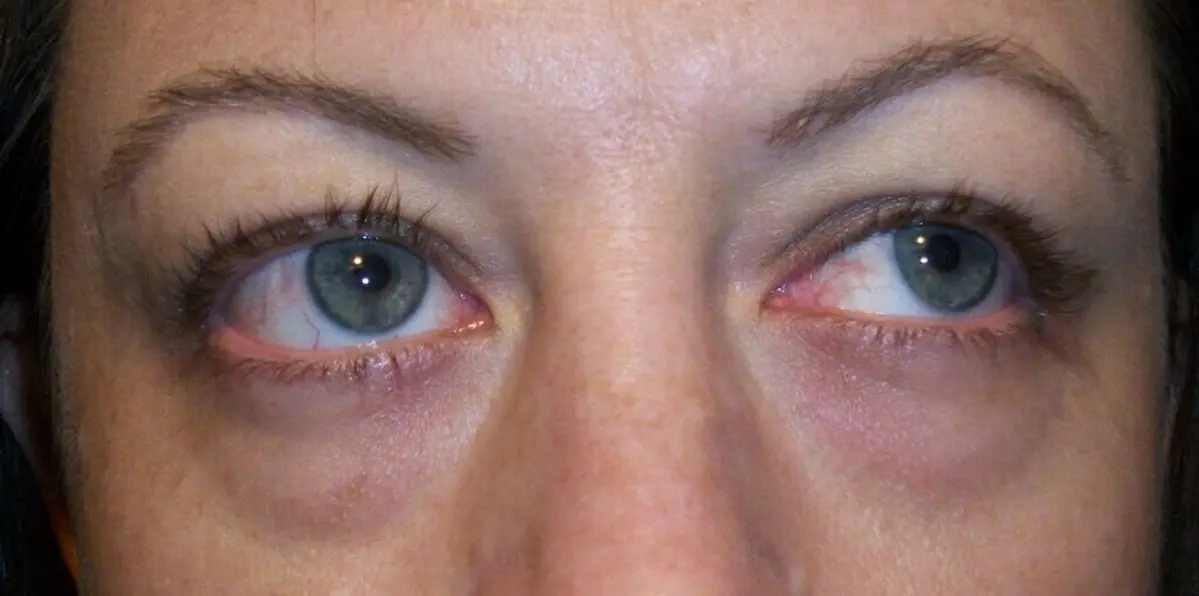 It's Not Just Fatigue: Why Dark Circles and Bags Form Under Your Eyes