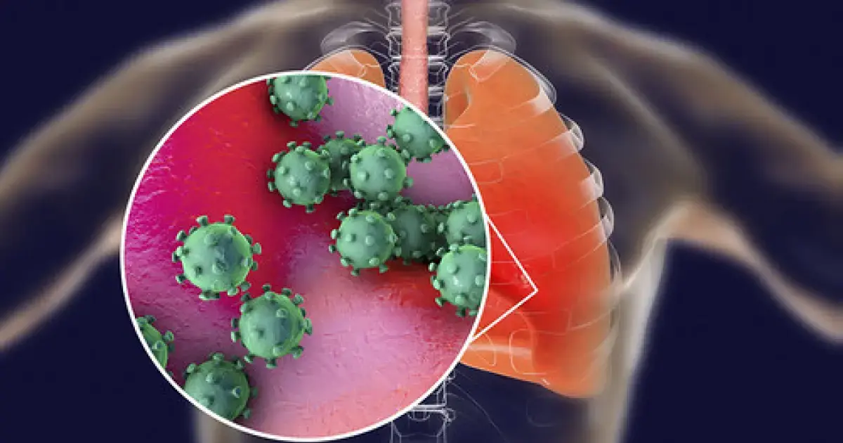 inflammation of the lungs