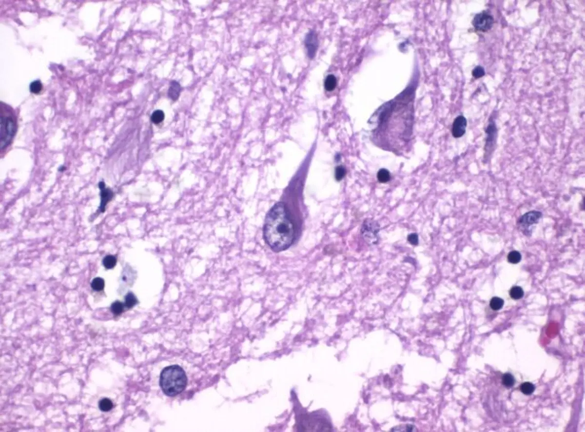 Insomnia Could Be an Early Warning Sign of Alzheimer’s 4 Tau proteins form tangles in a brain tissue sample.