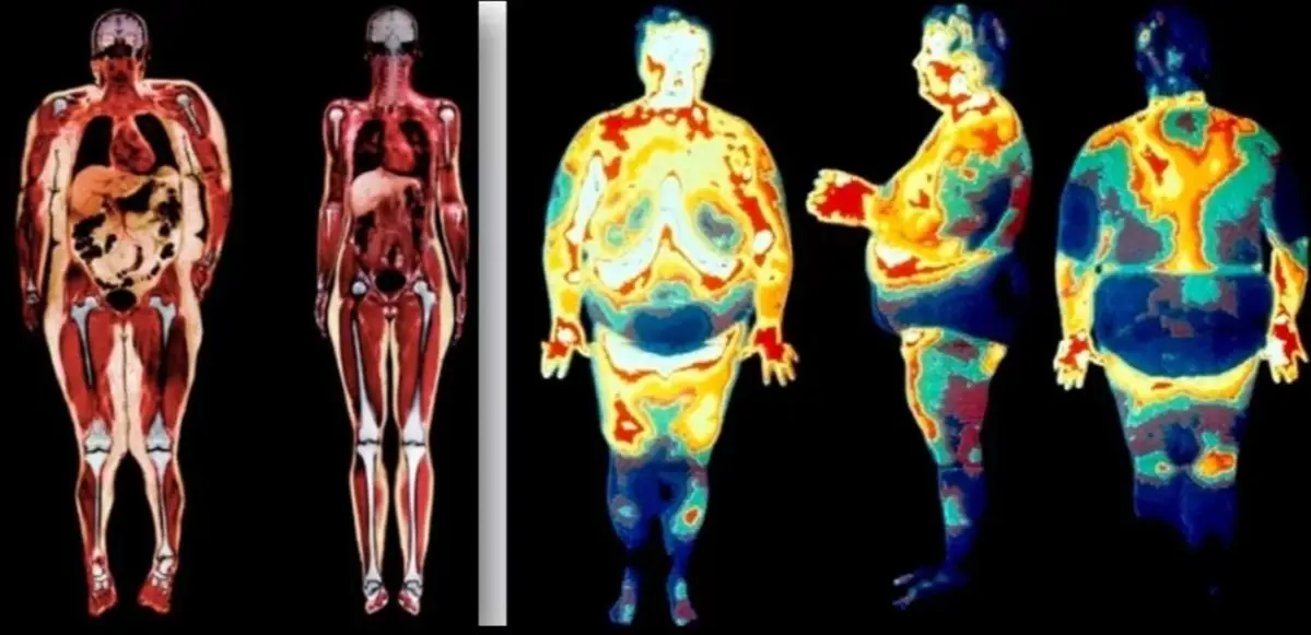 Scan showing how fat is deposited within the body