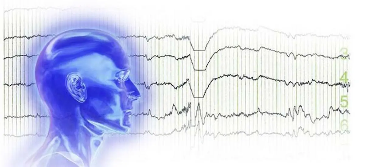 electroencephalogram (EEG)